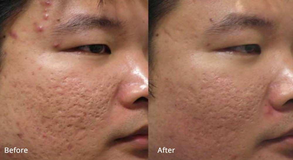 Richmond Hill Natural Therapies - Microneedling With Fractora