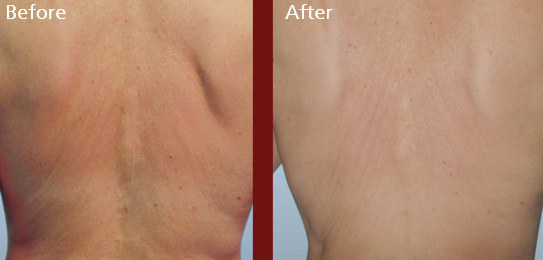 Richmond Hill Spa Namaste Forma Plus RF Skin Tightening For Body