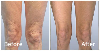 Richmond Hill Spa Namaste Forma Plus RF Skin Tightening For Body